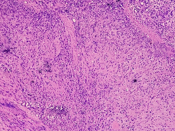 Profiling Sarcomas—The Search for a Matching Therapy
