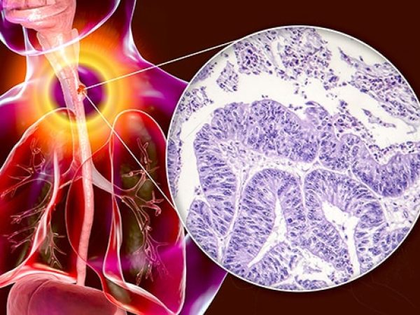 New Treatment Strategies for Esophageal Cancer 